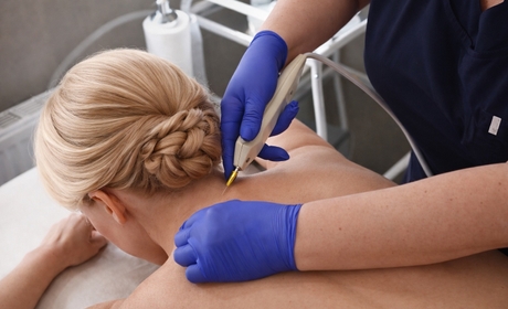 Карбокситерапия