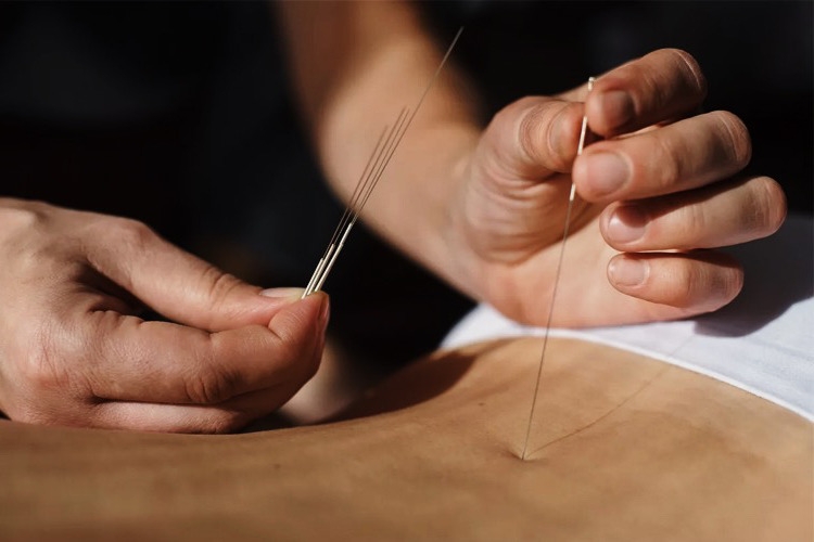 Медицинская рефлексотерапия