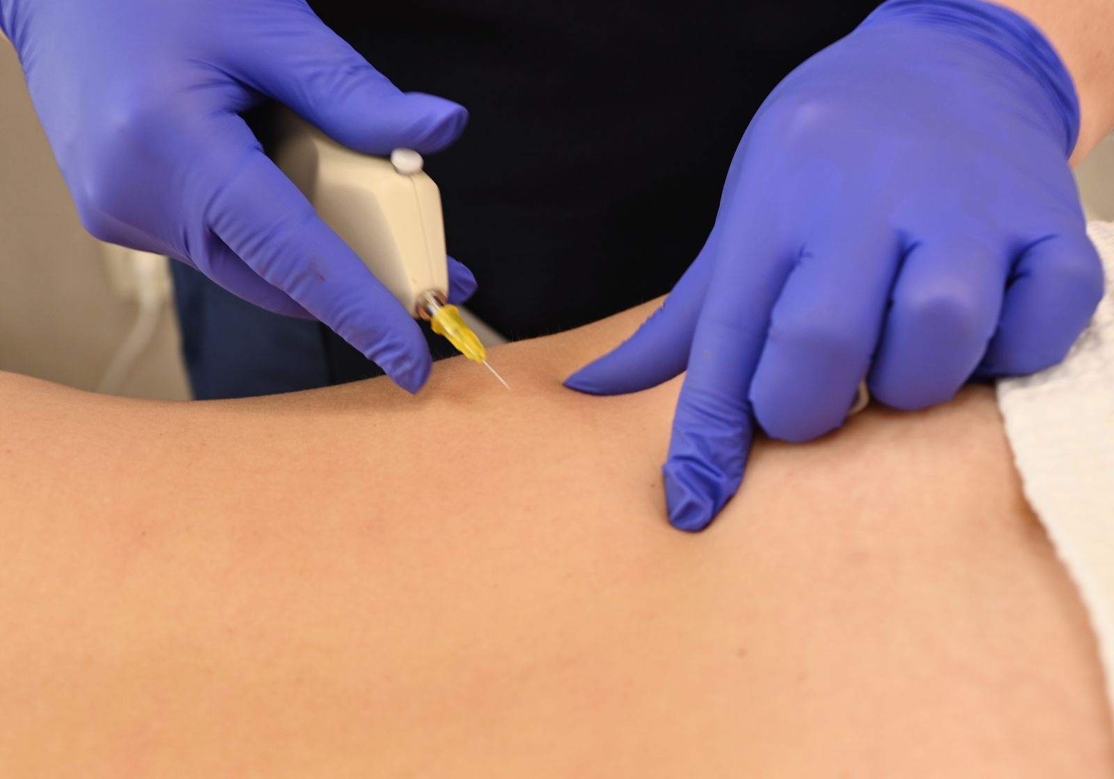 карбокситерапия